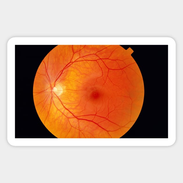 Healthy retina (P424/0175) Sticker by SciencePhoto